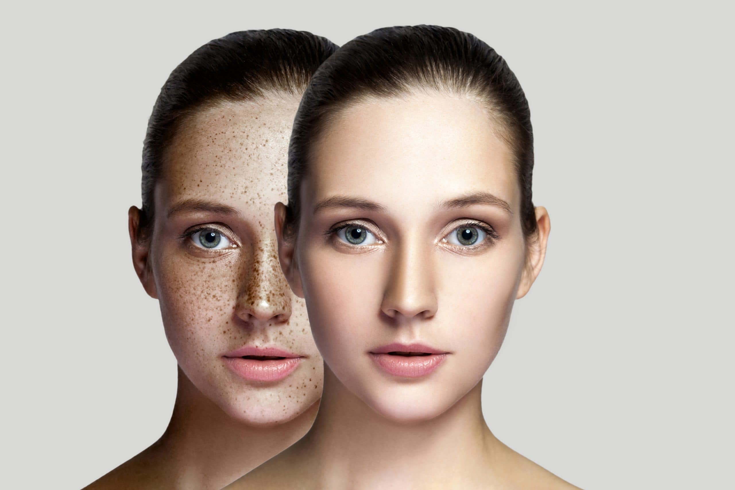 Chemical Peel Before and After